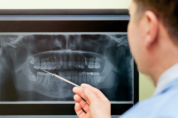 Will I Need A Bone Graft For The All On   Procedure?