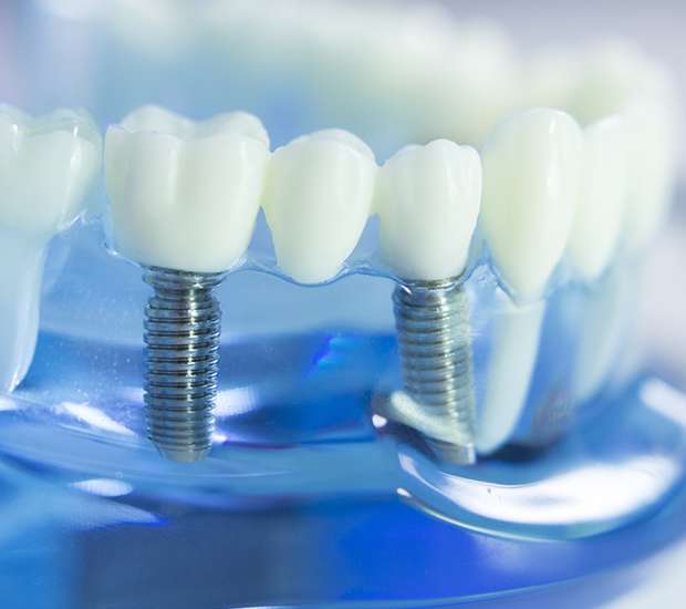 Hollywood Dental Implants