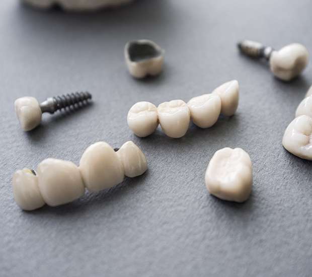 Hollywood The Difference Between Dental Implants and Mini Dental Implants