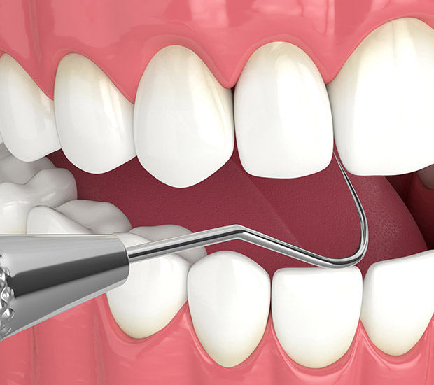 Hollywood Interactive Periodontal Probing