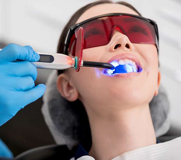 Hollywood Professional Teeth Whitening