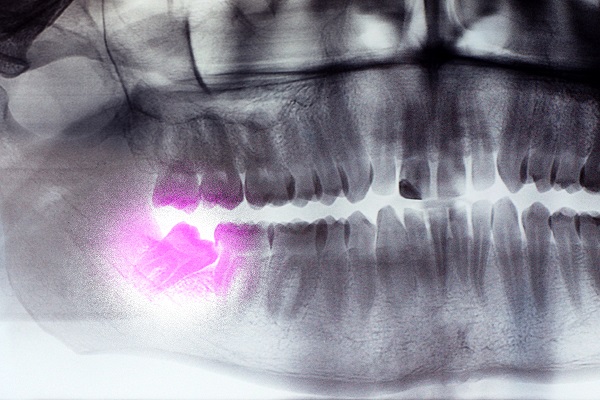 What Age Should I Consider A Wisdom Tooth Extraction?